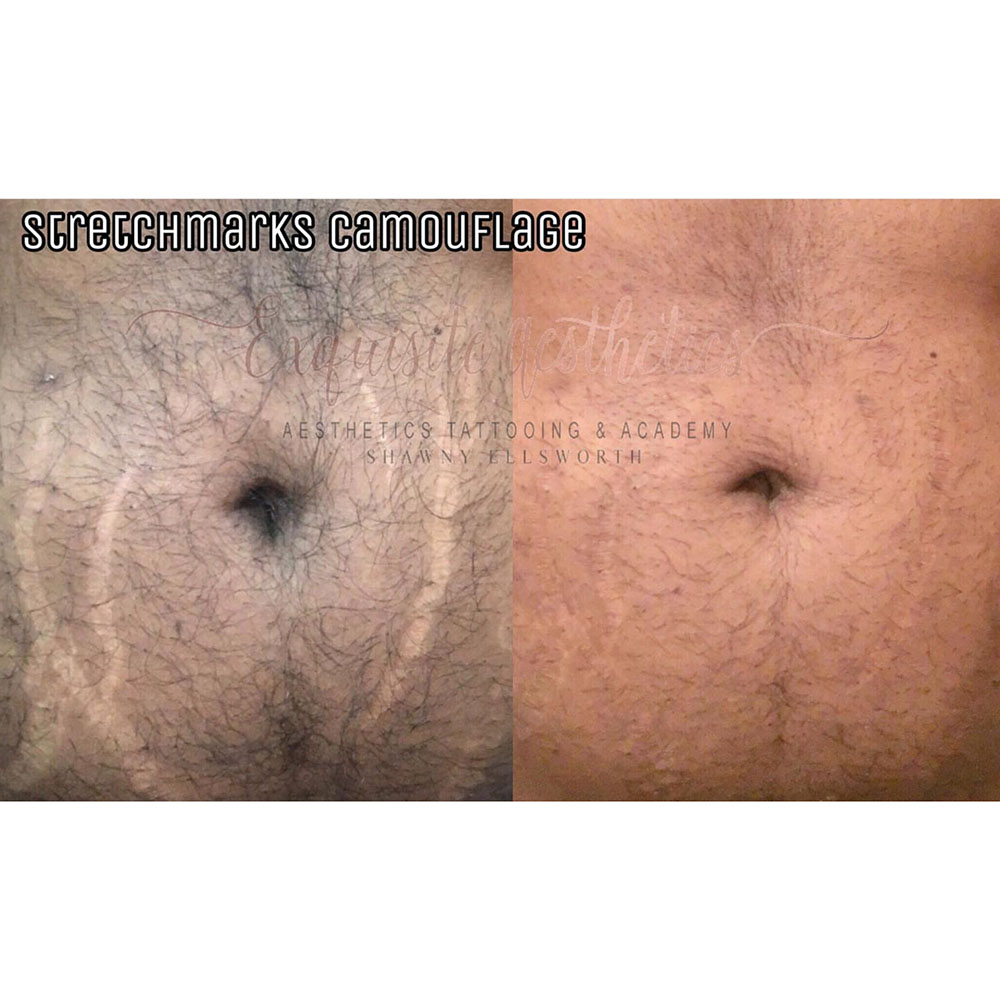 Stretch Mark And Scar Treatment Contour Body Lab