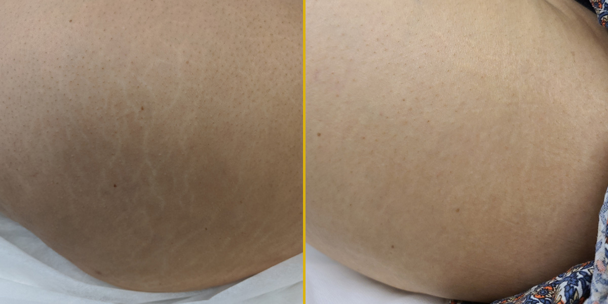 Stretch Marks - Kamloops Skin Solutions