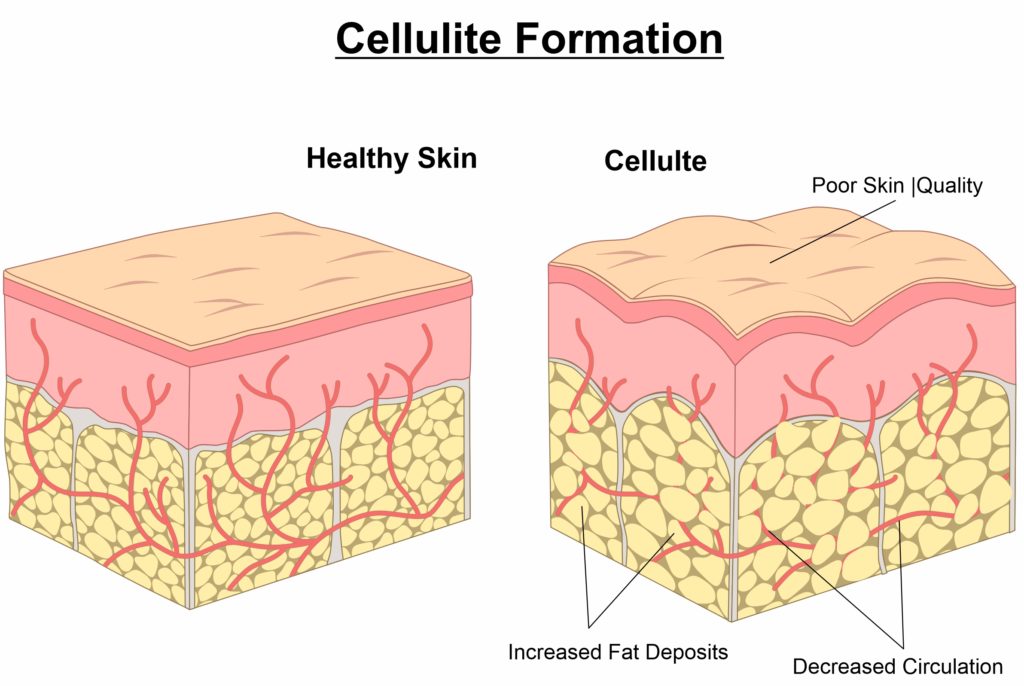 Marking target areas for cellulite reduction (a). examples of
